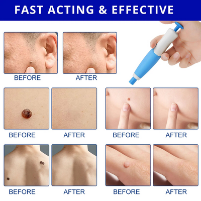 50% RABATT | Dermavex™ | Hautanhänger Entferner – Sanft & Wirksam