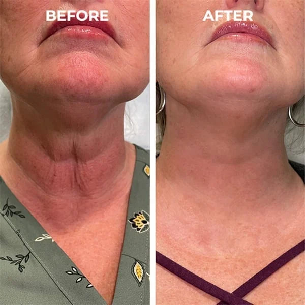 1+1 GRATIS | GlowTox™ | Glatte, jugendliche Haut mit Botox Anti-Aging Serum